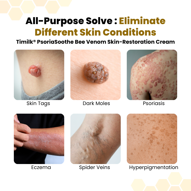 Alcuras® PsoriaSoothe Bee Venom Skin-Restoration Cream