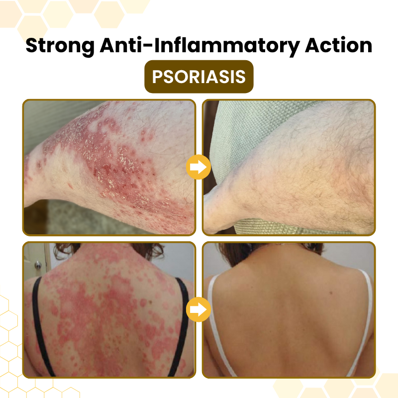 Alcuras® PsoriaSoothe Bee Venom Skin-Restoration Cream